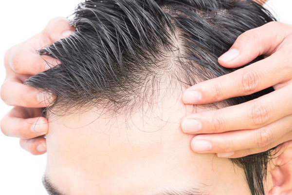 caida pelo hombre